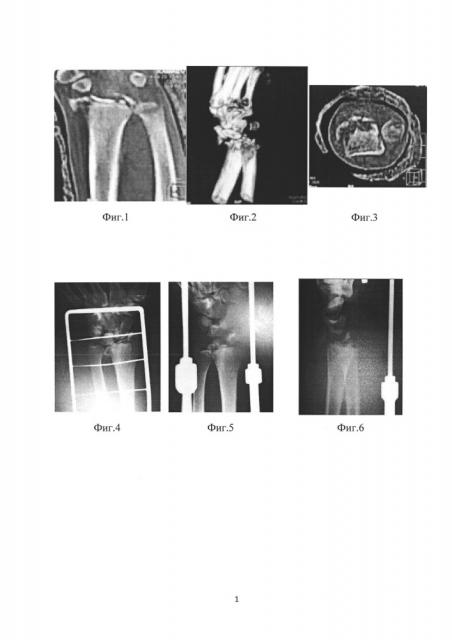 Способ артропластики дистального отдела лучевой кости при многооскольчатых внутрисуставных переломах дистального отдела лучевой кости (патент 2641379)