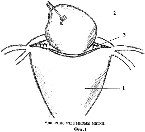 Способ удаления миомы матки (патент 2411008)