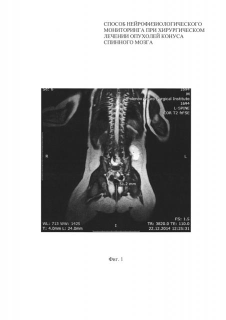 Способ нейрофизиологического мониторинга при хирургическом лечении липом конуса спинного мозга (патент 2621411)