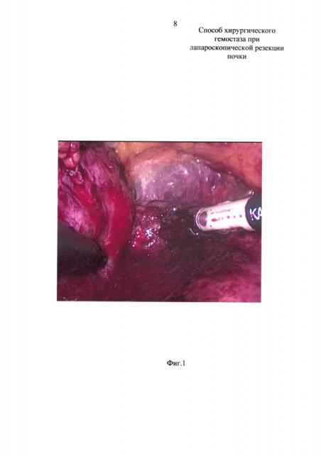 Способ хирургического гемостаза при лапароскопической резекции почки (патент 2654402)