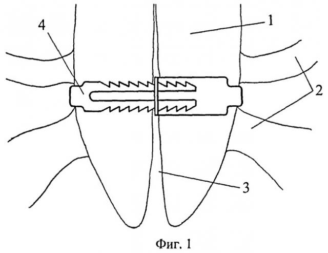 Устройство для фиксации грудины после стернотомии (патент 2391934)