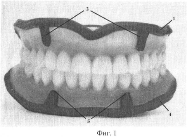 Способ изготовления полных съемных зубных протезов (патент 2448665)