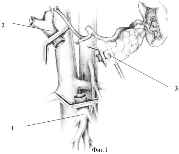 Способ панкреатодуоденальной резекции при местнораспространенном раке периампулярной области с опухолевой инвазией воротной и верхней брыжеечной вены (патент 2336832)