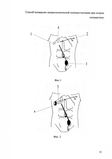 Способ конверсии лапароскопической холецистэктомии при остром холецистите (патент 2661072)