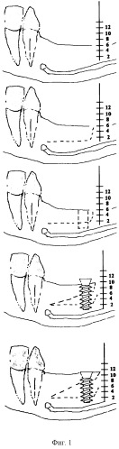 Способ увеличения (винтовой дистракции) костной ткани и костный дистрактор (патент 2302218)