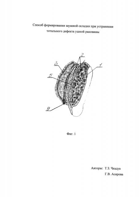 Способ формирования заушной складки при устранении тотального дефекта ушной раковины (патент 2626989)