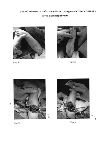 Способ лечения разгибательной контрактуры локтевого сустава у детей с артрогрипозом (патент 2585744)