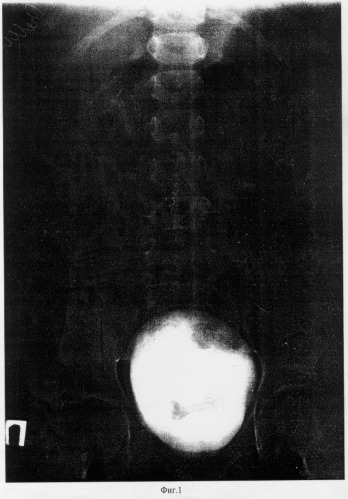 Способ рентгенодиагностики степени пузырно-мочеточникового рефлюкса у детей (патент 2283621)