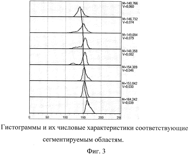 Способ диагностики патологии околоносовых пазух путем распознавания образов (патент 2585700)