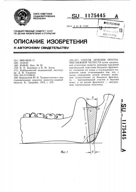 Способ лечения прогнатии нижней челюсти (патент 1175445)