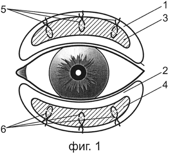 Способ хирургического лечения послеожогового выворота верхнего и нижнего век (патент 2578846)