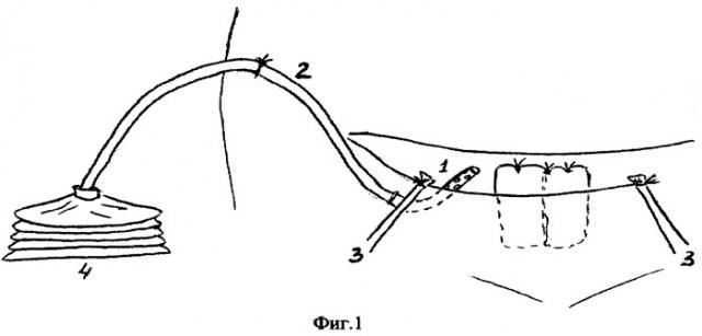 Способ активного дренирования параметрия после гистерэктомии по поводу перешеечного расположения узла миомы (патент 2296521)
