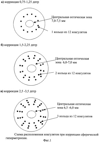 Способ лечения гиперметропии и гиперметропического астигматизма (патент 2313322)