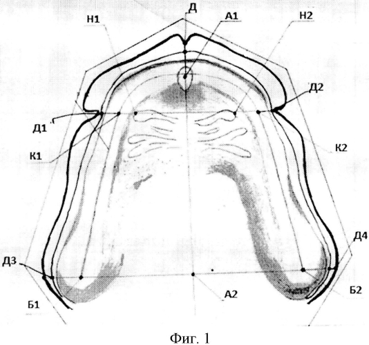 Способ диагностики атрофии беззубых челюстей (патент 2565816)