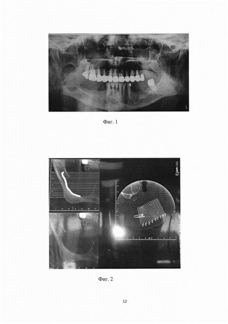 Способ хирургического лечения кистозных образований нижней челюсти больших размеров (патент 2610332)