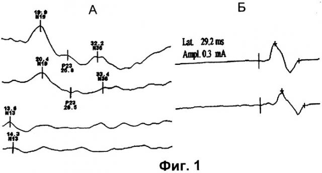 Способ определения характера компрессии спинного мозга на шейном уровне при дегенеративных стенозах (патент 2317119)
