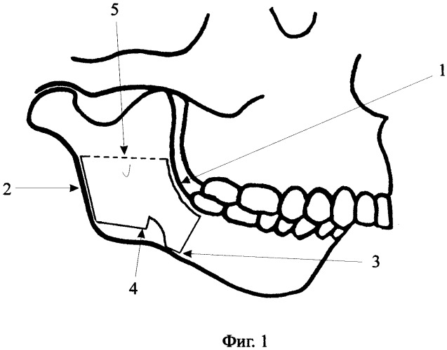 Способ увеличения длины тела и ветви нижней челюсти у детей (патент 2362499)