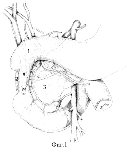 Способ хирургического лечения постбульбарных язв двенадцатиперстной кишки, осложненных холедоходуоденальным свищом (патент 2316262)