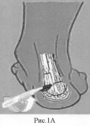 Способ хирургического лечения плоско-вальгусной деформации стоп у детей с врожденным вертикальным тараном (патент 2405491)