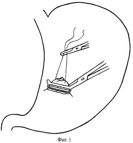 Способ хирургического лечения осложненных язв желудка (патент 2261666)