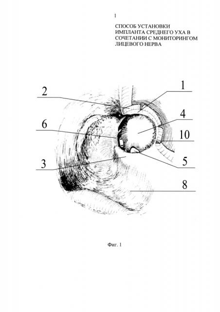 Способ установки импланта среднего уха в сочетании с мониторингом лицевого нерва (патент 2616174)