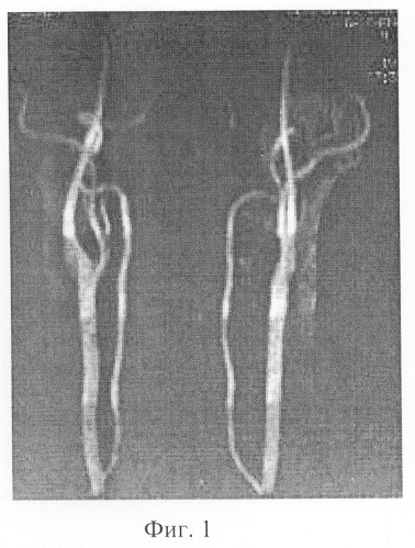 Способ диагностики патологии позвоночных артерий (патент 2295285)