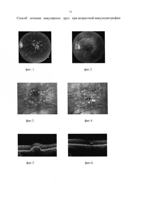 Способ лечения макулярных друз при возрастной макулодистрофии (патент 2647142)