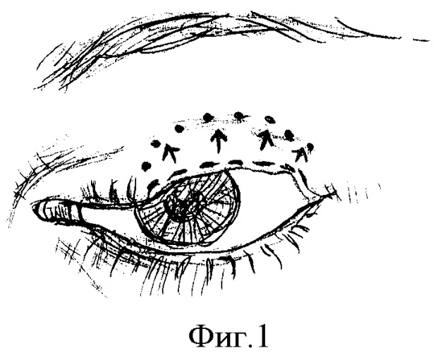 Способ устранения сквозного краевого дефекта верхнего века (патент 2380066)