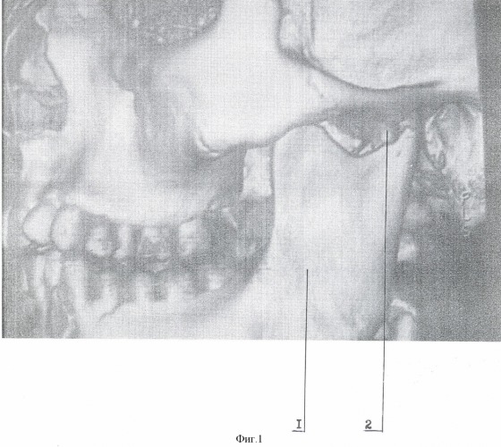 Способ хиругического лечения переломов-вывихов головки суставного отростка нижней челюсти (патент 2355335)
