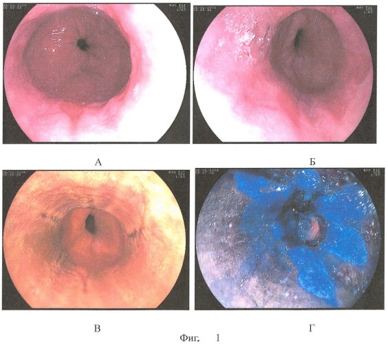 Способ комбинированной хромоскопии пищевода (патент 2408251)