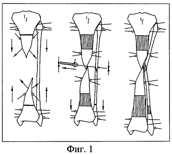 Способ лечения дефектов длинных трубчатых костей (патент 2264184)
