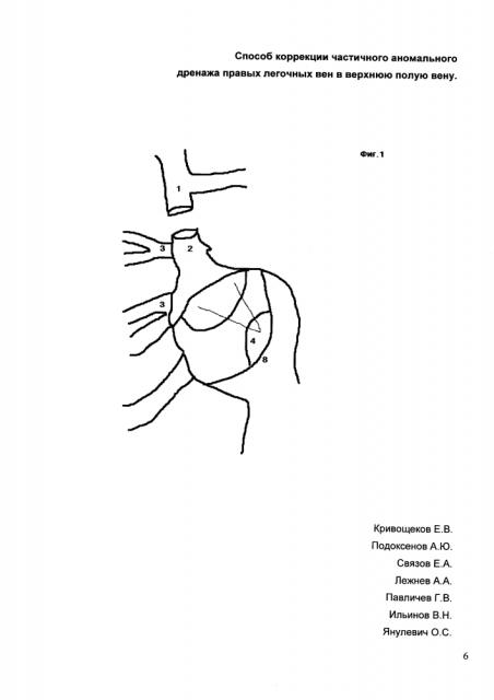 Способ коррекции частичного аномального дренажа правых легочных вен в верхнюю полую вену (патент 2604716)
