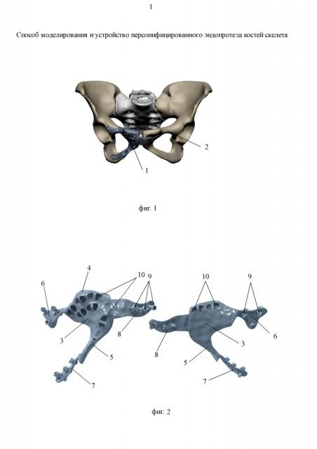 Способ моделирования и устройство персонифицированного эндопротеза костей скелета (патент 2651104)