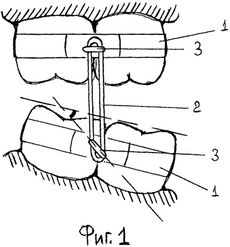 Несъемный аппарат для лечения дисфункций височно-нижнечелюстного сустава (патент 2541825)