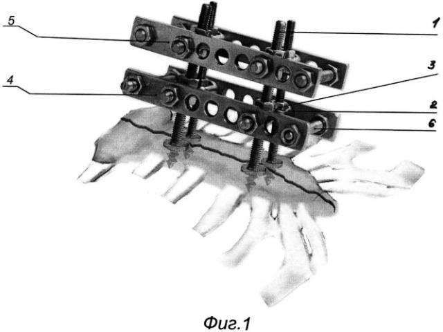 Устройство для стабилизации переломов и замещения дефектов ребер и грудины (патент 2526448)