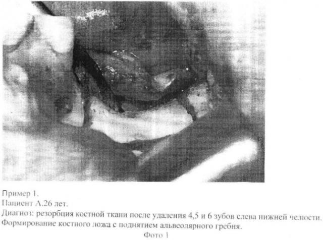 Способ пластики альвеолярного отростка нижней челюсти (патент 2405474)