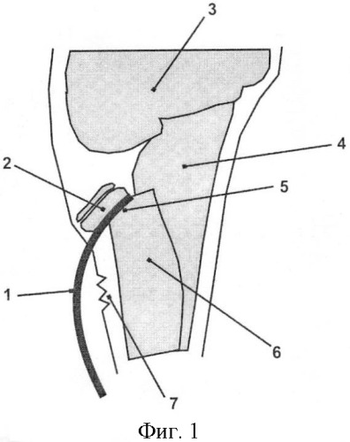 Способ чрескожной репозиции спицей перелома шейки лучевой кости у детей (патент 2408319)