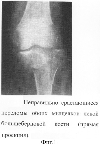 Способ остеосинтеза с использованием костной аллопластики (патент 2299028)