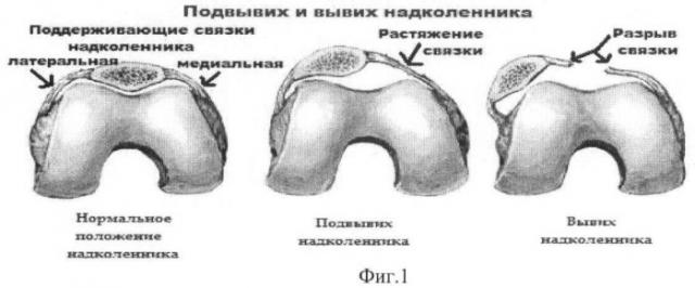 Способ хирургического восстановления медиальной пателлофеморальной связки при травматическом вывихе надколенника у детей (патент 2427341)