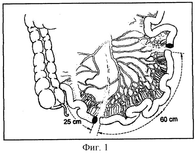 Способ ортотопической кишечной пластики мочевого пузыря (патент 2279254)
