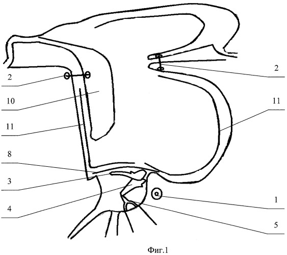 Способ операции при атрезии наружного слухового прохода (патент 2426500)