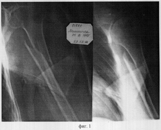 Способ остеосинтеза диафизарных переломов плечевой кости (патент 2312632)
