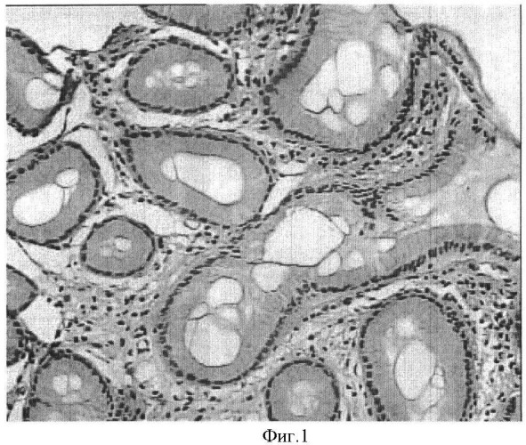 Способ лечения helicobacter pylori ассоциированной хронической язвенной болезни желудка и двенадцатиперстной кишки (патент 2416408)