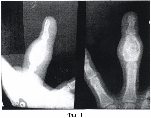 Способ лечения энхондром фаланг и пястных костей кисти (патент 2489107)