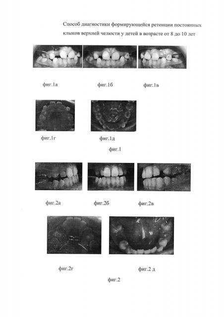 Способ диагностики формирующейся ретенции постоянных клыков верхней челюсти у детей в возрасте от 8 до 10 лет (патент 2629329)