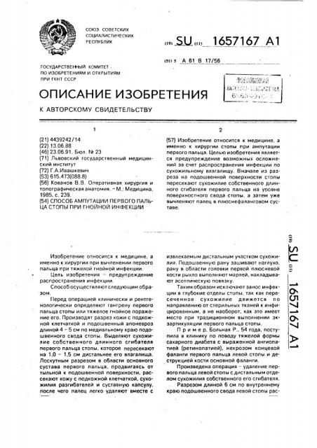 Способ ампутации первого пальца стопы при гнойной инфекции (патент 1657167)