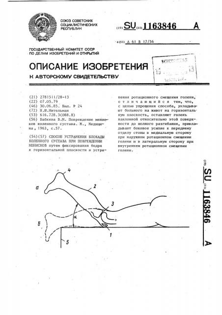 Способ устранения блокады коленного сустава при повреждении менисков (патент 1163846)