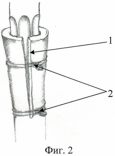 Способ продольной остеотомии проксимального отдела бедренной кости при установке бедренного компонента тазобедренного сустава (патент 2411013)