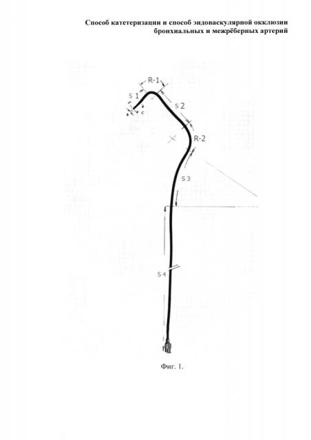 Способ катетеризации и способ эндоваскулярной окклюзии бронхиальных и межрёберных артерий (патент 2661097)