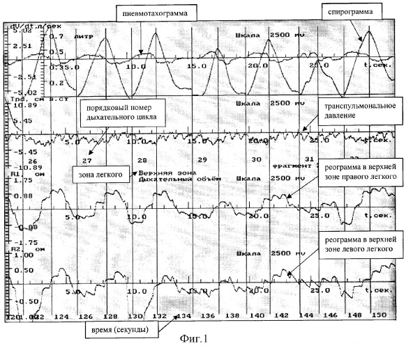 Способ определения регионарной механической активности легких (патент 2328970)